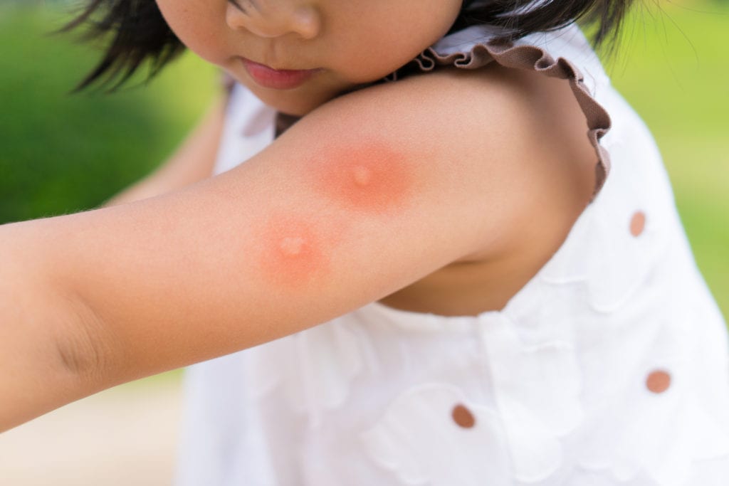 Girl with mosquito bites